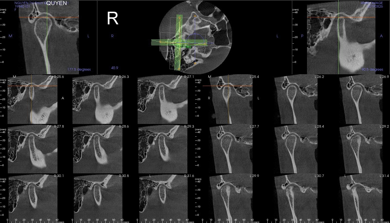 Conebeam CT khớp thái dương hàm